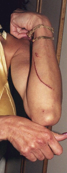 Cuts on Arm